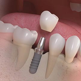 Side_cut_of_titanium_implant