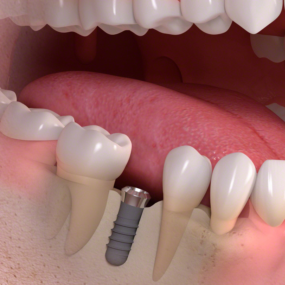 Size_of_an_implant-borne_artifical_tooth